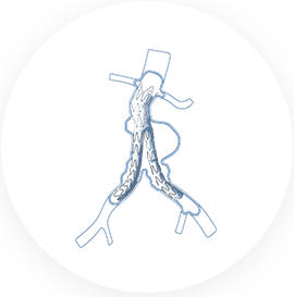 Hercules™ Bifurcated Stent-Graft System