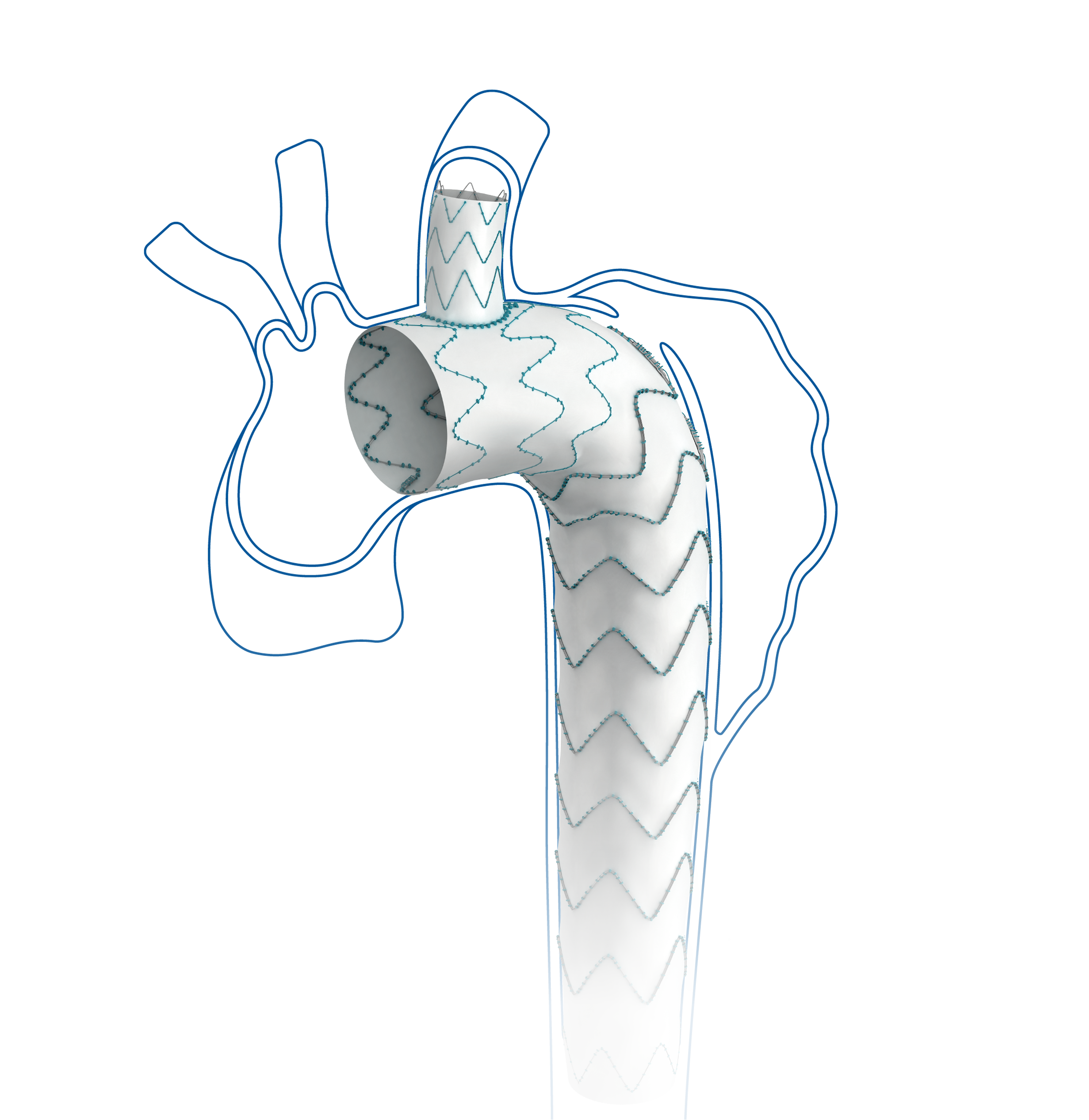 Castor™ Branched Aortic Stent-Graft and Delivery System