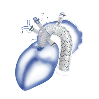 Fontus™ Branched Stent Graft System in Surgical Operation